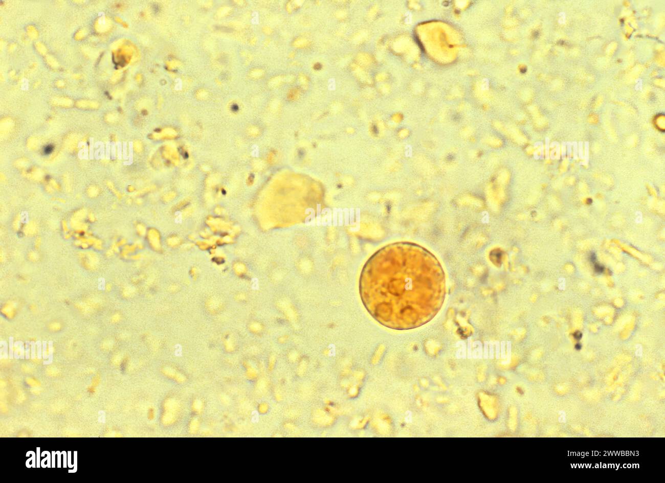 Dieser jodgefärbte Photomikrograph zeigte das Vorhandensein einer Amoeba histolytica-Amoeba-Parasitenzyste. Stockfoto