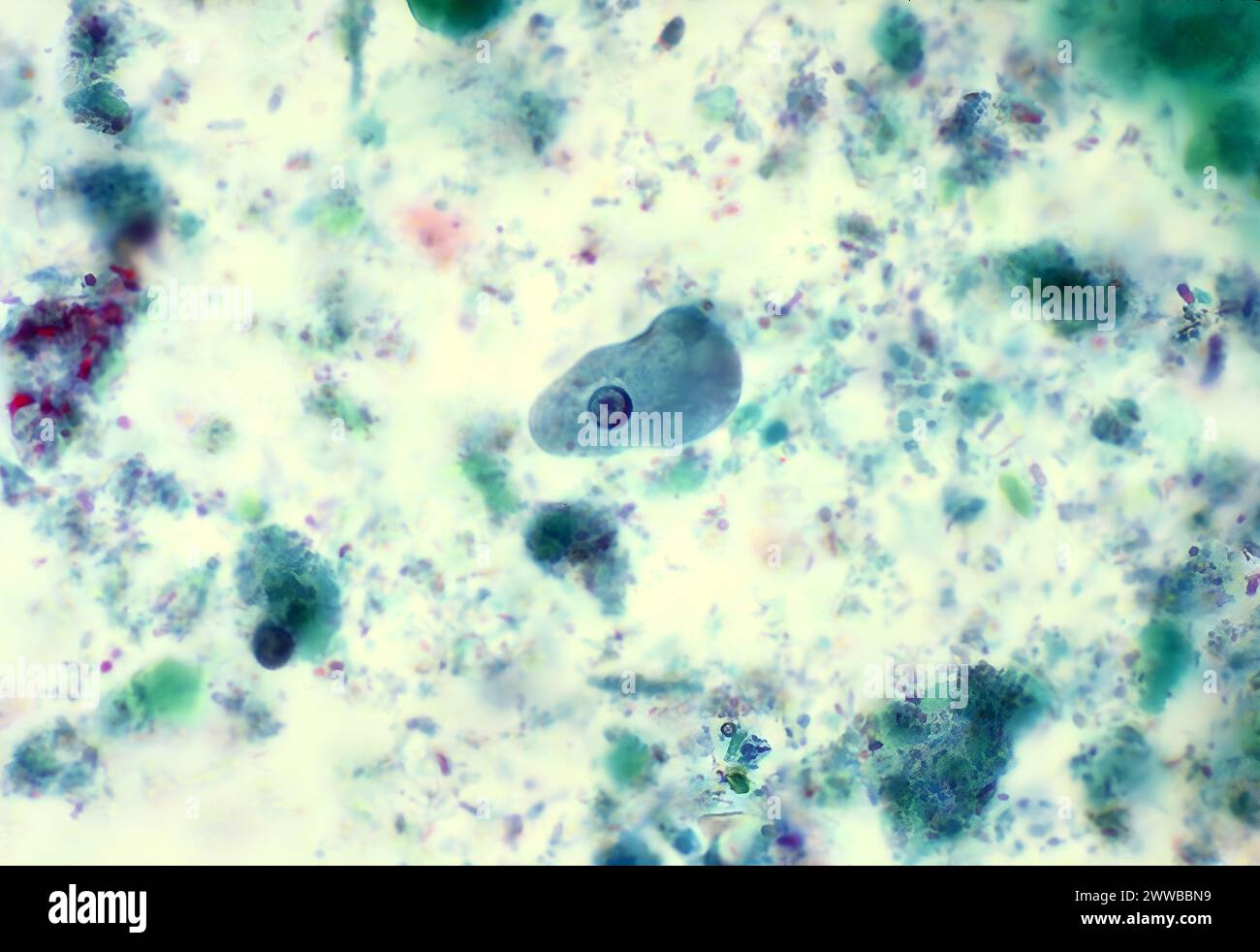 Auf diesem trichromen Objektträger wurde ein Entamoeba histolytica trophozoit entdeckt, der einen atypischen Kern aufweist. Stockfoto