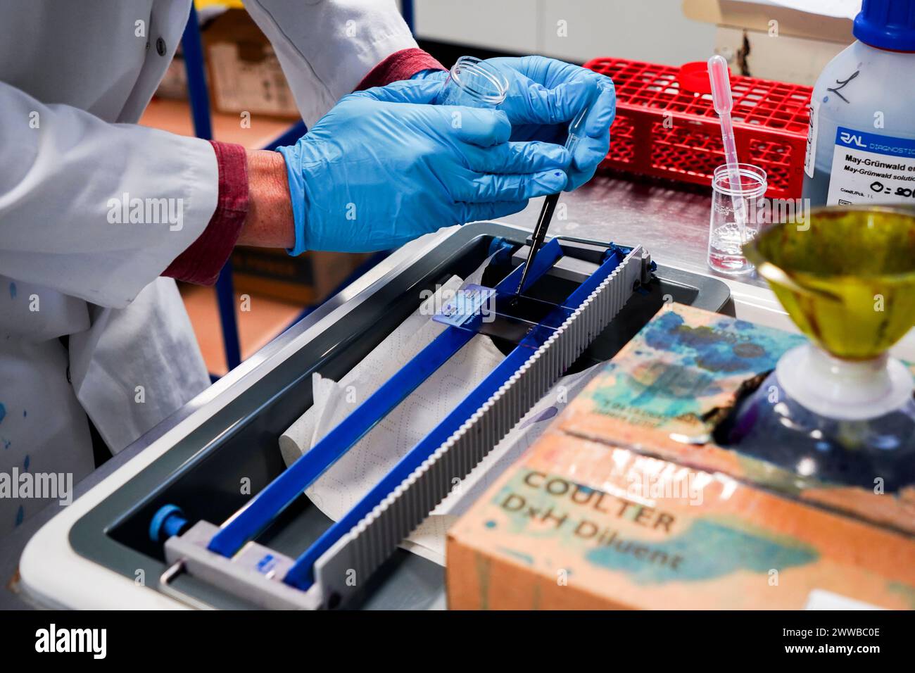 Technische Plattform des Laboratoriums Inovie 34. Färbung eines Malariabildes und Diagnoseausstrichs zum Ausschluss von Malaria bei einem Patienten. Stockfoto