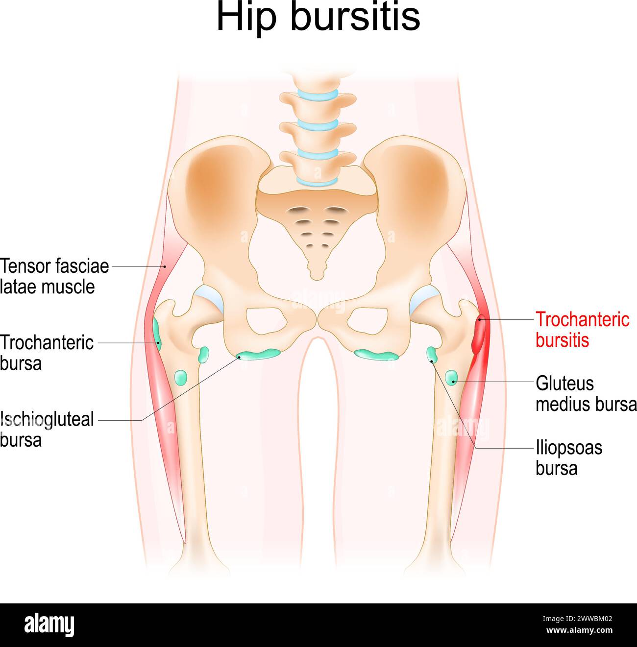Hüftbursitis. Muskeln, Synovialbursas und Knochen einer menschlichen Hüfte. Trochantere Bursitis. Realistische Vektordarstellung Stock Vektor