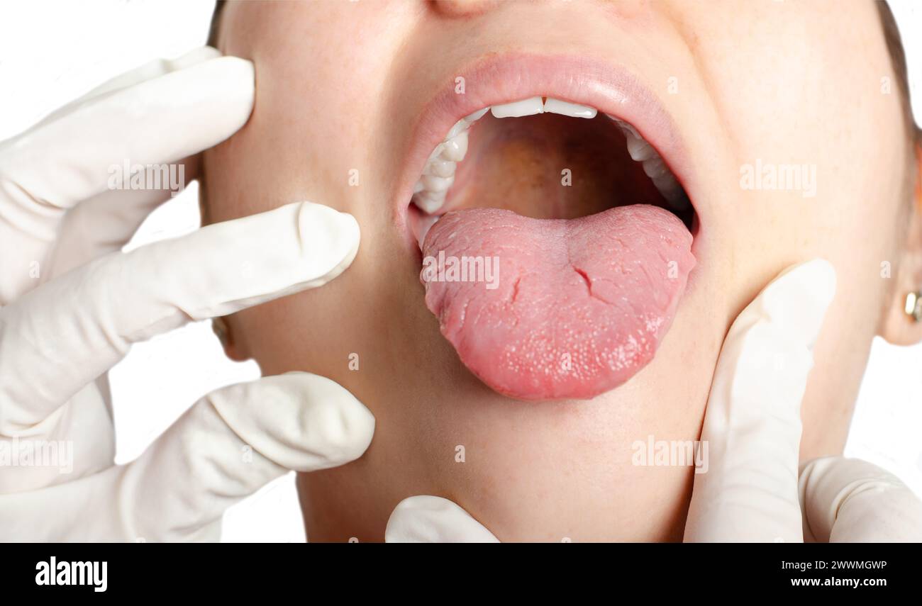 Junge Frau mit geographischer Zunge. Migrationsglossitis. Stockfoto
