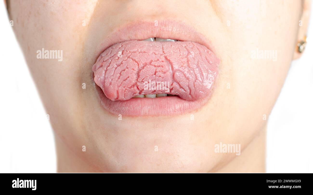 Frau mit geographischer Zunge. Migrationsglossitis. Stockfoto