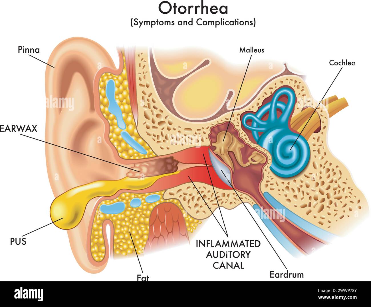 Medizinische Illustration einiger Symptome und Komplikationen der Otorrhoe, eine Pathologie, die das Ohr beeinflusst, mit Anmerkungen. Stock Vektor