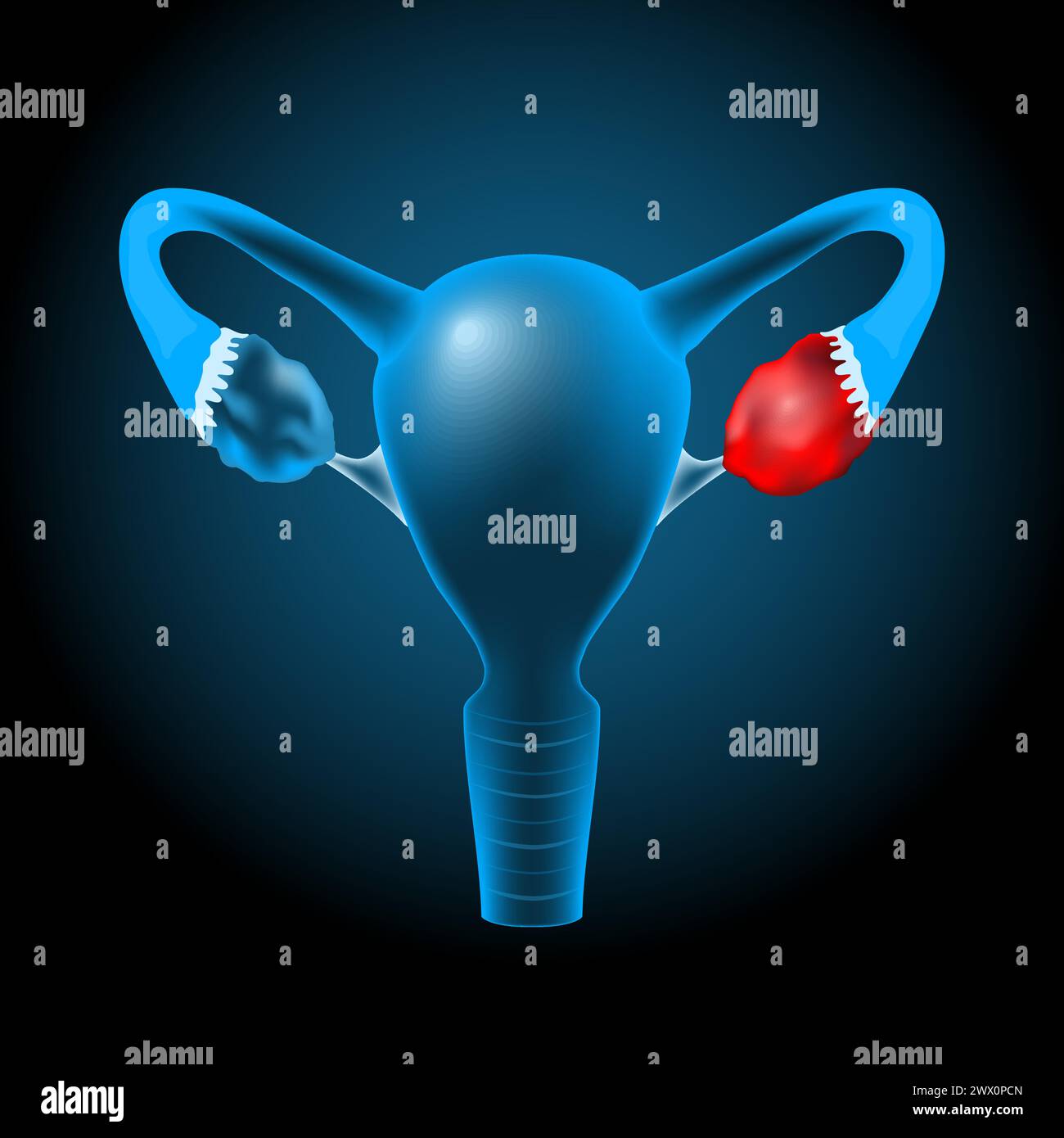 Realistisch transparenter blauer menschlicher Uterus mit leuchtender Wirkung auf dunklem Hintergrund. Ovarialzyste oder Tumor im Ovar. Vektorabbildung li Stock Vektor