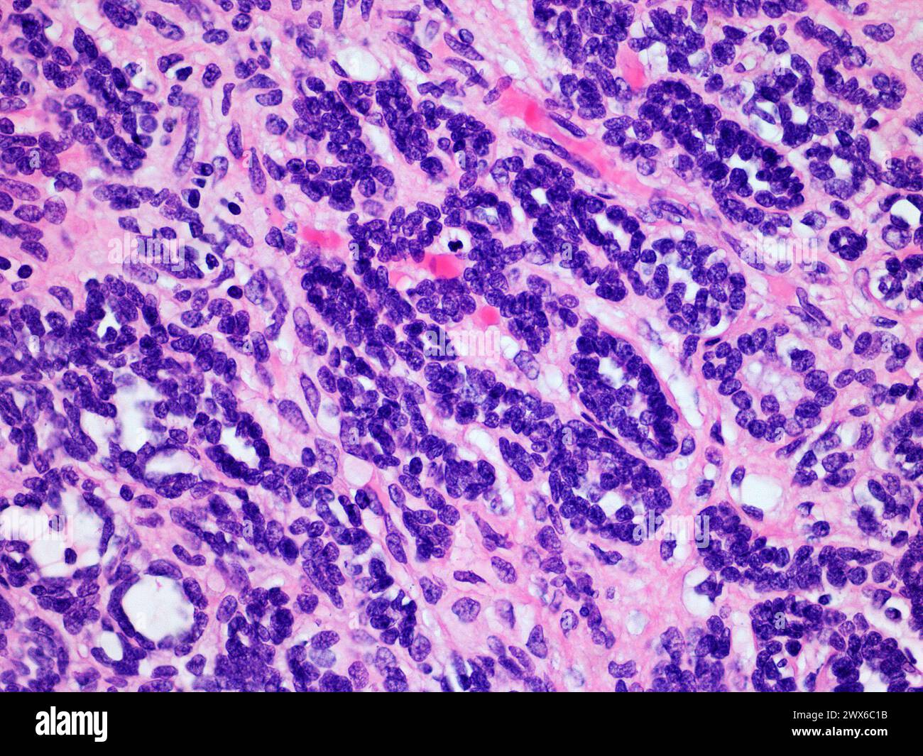 Mikroskopisches Bild eines Wilms-Tumors oder Nephroblastoms einer Kinderniere mit 400-facher Vergrößerung mit Hämatoxylin- und Eosin-Färbung Stockfoto