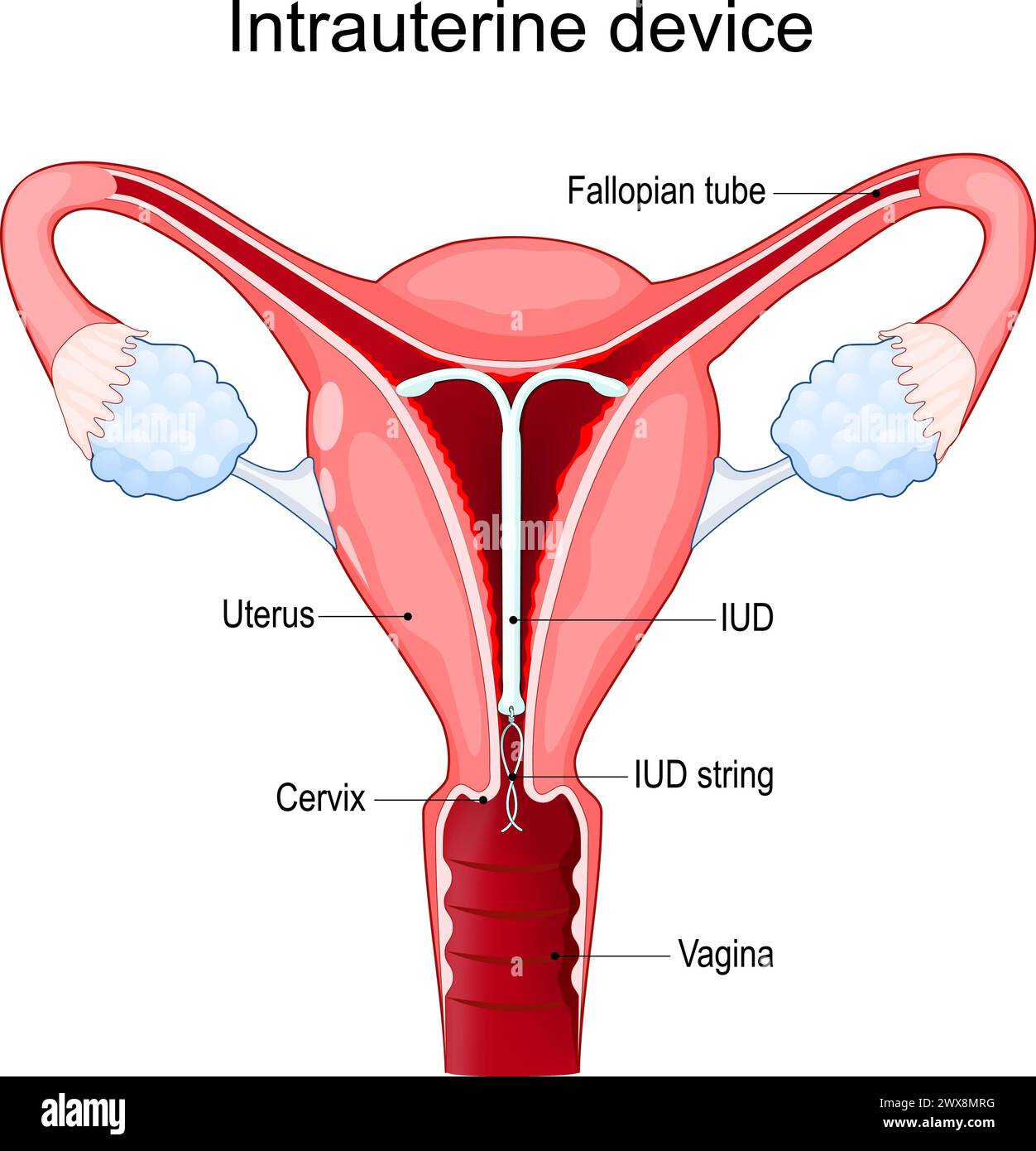 Intrauterines Gerät oder Spule. IUD. Intrauterine Kontrazeptiva zur Geburtenkontrolle. Querschnitt eines menschlichen Uterus mit IUCD oder ICD im Inneren. Vektor Stock Vektor