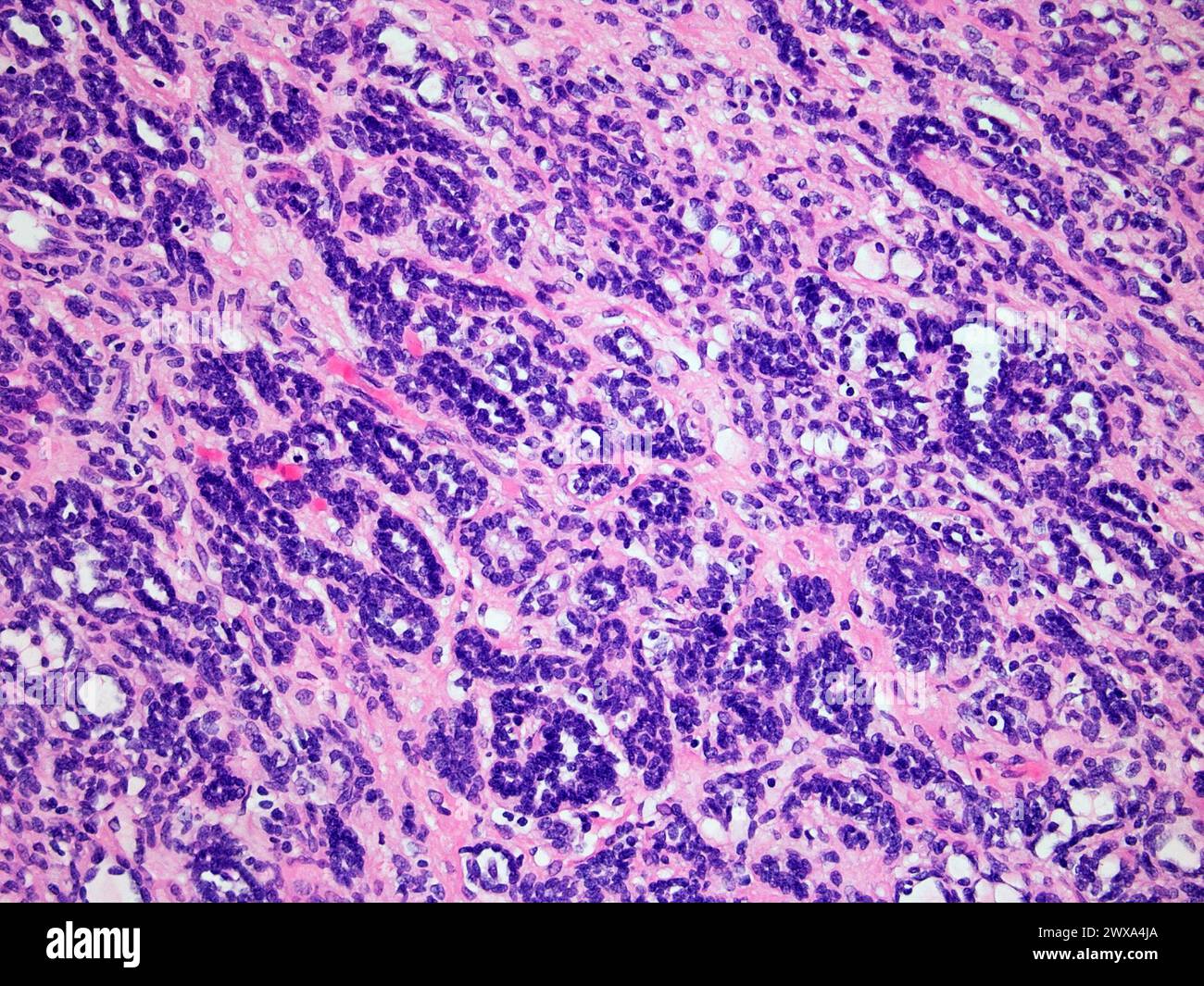 Wilms-Tumor oder Nephroblastom einer Kinderniere bei 200-facher Vergrößerung mit Hämatoxylin- und Eosin-Färbung eines der häufigsten Krebsarten Affec Stockfoto