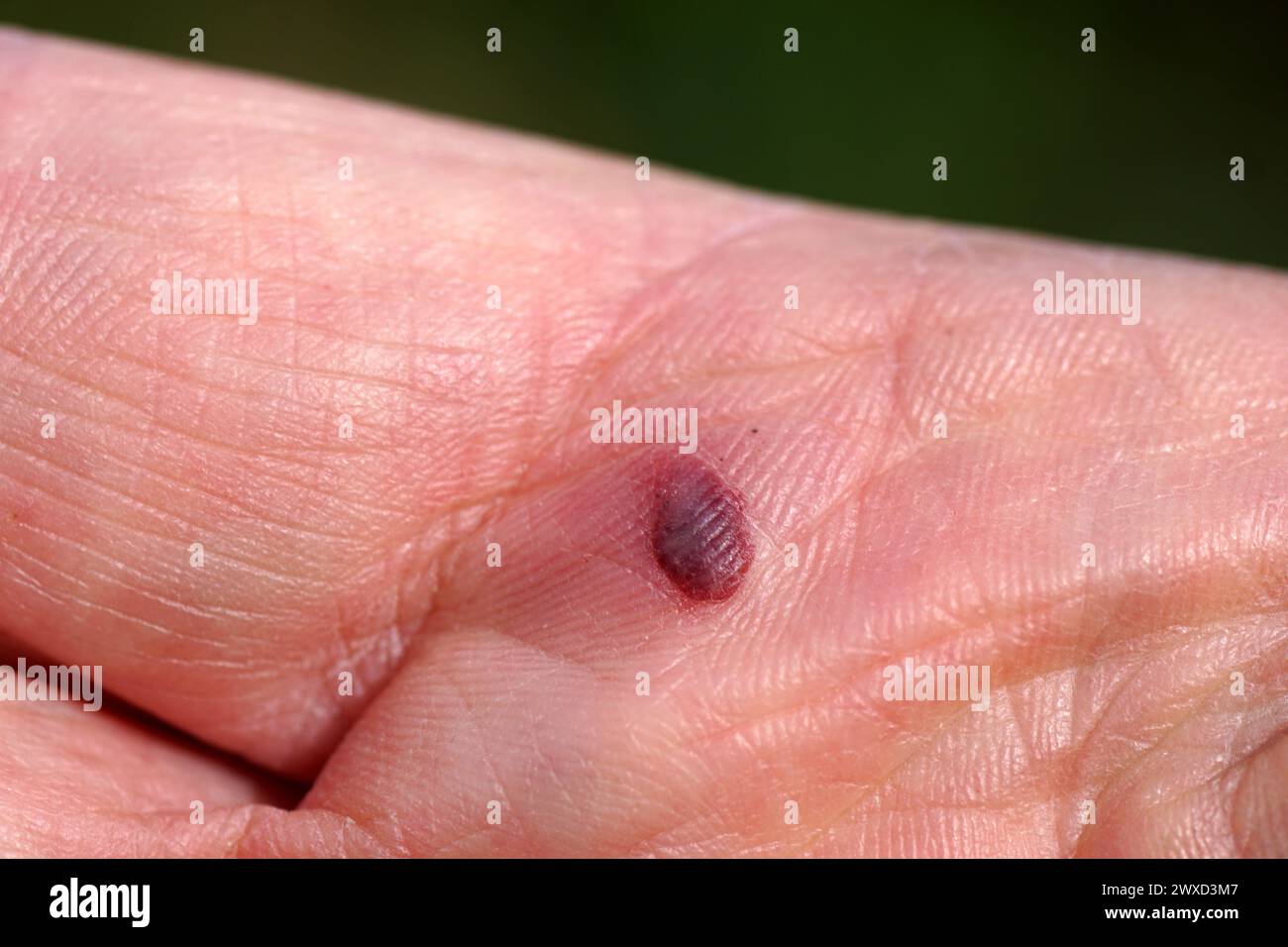 Nahblutblase auf der Handfläche einer offenen Hand. Stockfoto