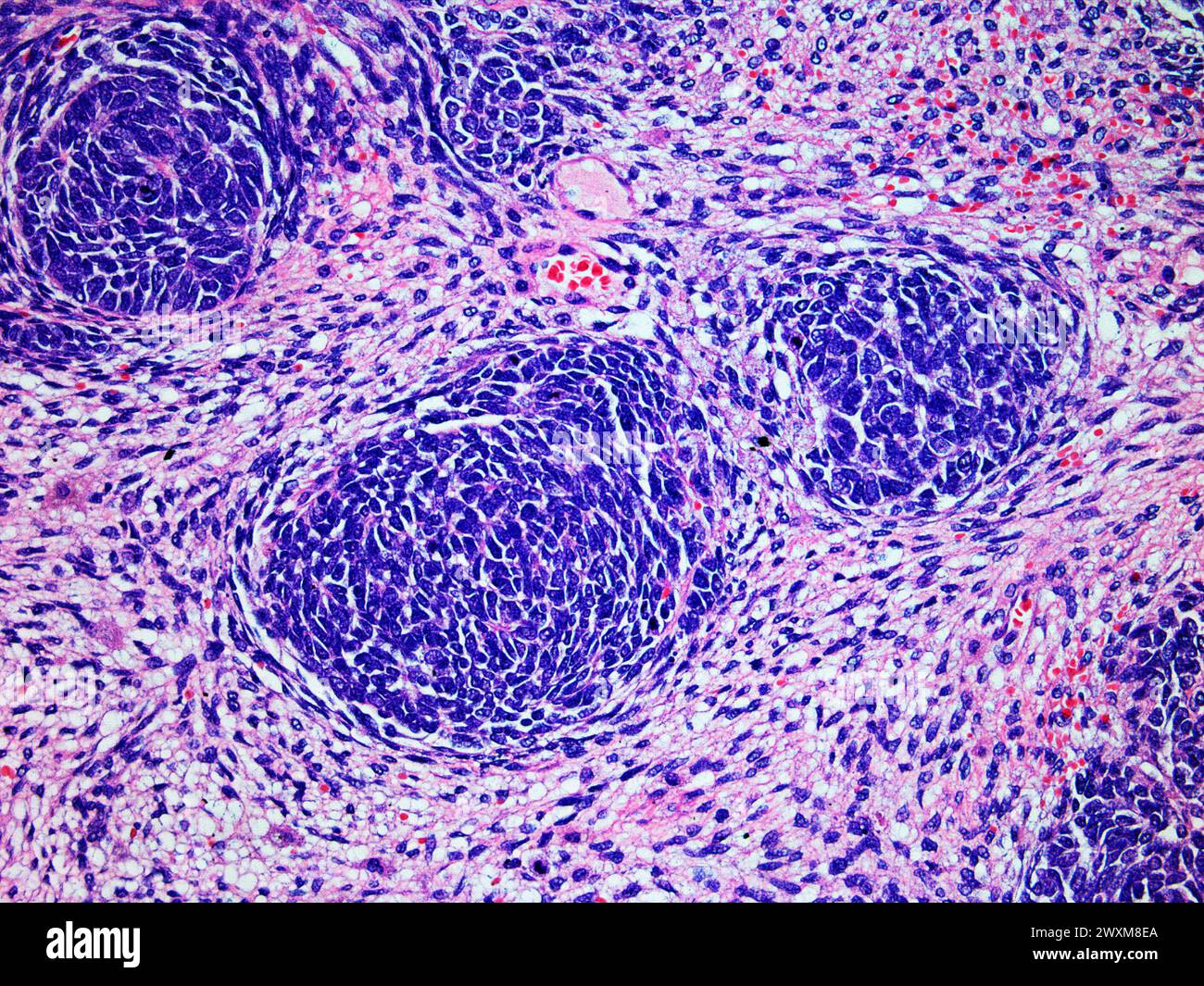 Mikroskopisches Bild eines Wilms-Tumors oder Nephroblastoms einer Kinderniere bei 200-facher Vergrößerung mit Hämatoxylin- und Eosin-Färbung eines der Mo Stockfoto