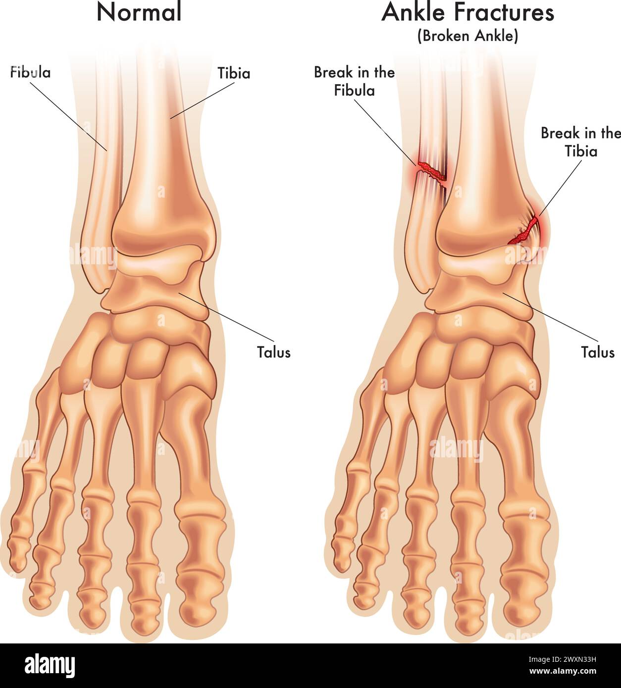 Die medizinische Illustration vergleicht einen normalen Fußgelenksfuß mit einem Fußgelenksbruch an zwei Stellen mit Beschriftungen. Stock Vektor