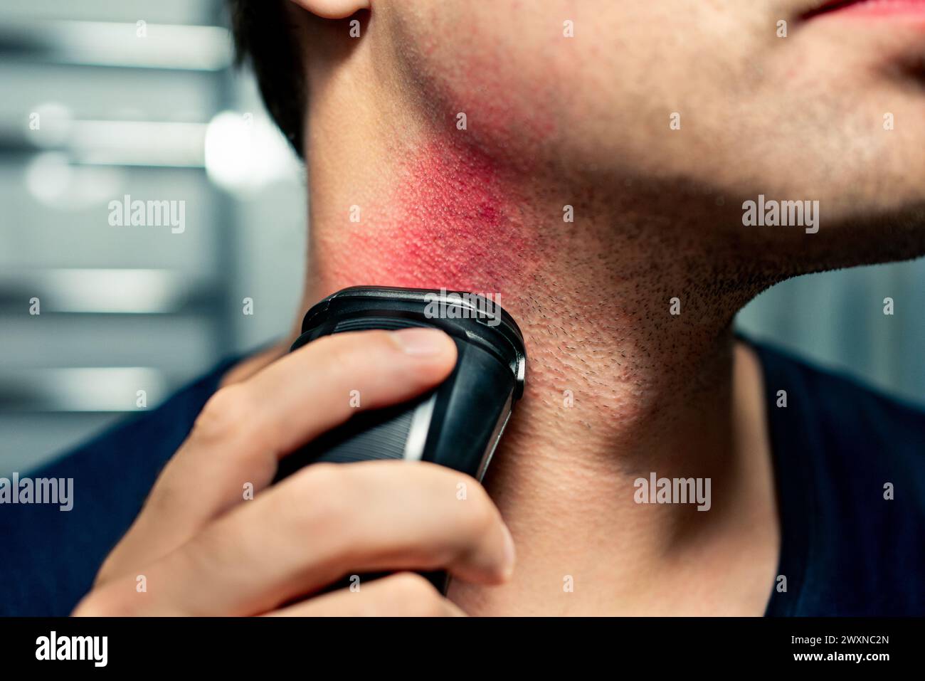 Rasierbrand, Hautausschlag und Hautirritationen. Elektrorasierer. Eingewachsenes Haar im Gesicht. Problem mit der Bartpflegemaschine und dem Trimmer. Mann im Badezimmer. Stockfoto