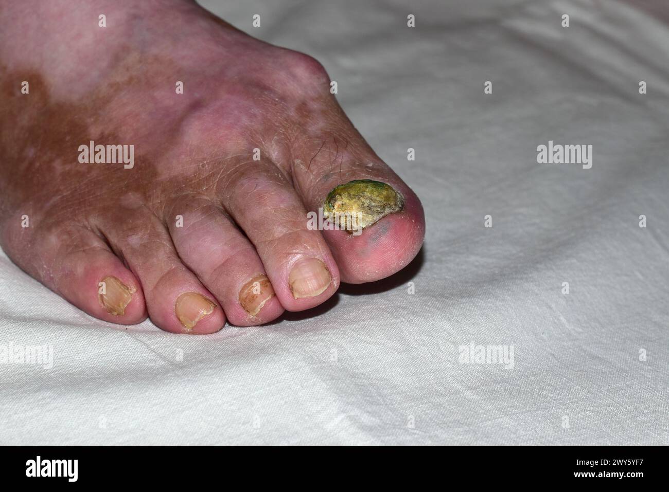 Das Bild zeigt eine Nahaufnahme des rechten Fußes mit einem keratinösen Pilzwuchs auf dem Großzehennagel. Stockfoto