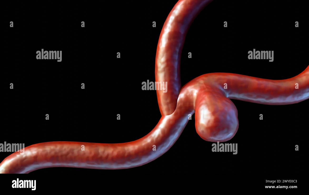 Die 3D-Darstellung eines Sakkularaneurysmas, auch bekannt als Beerenaneurysma, ist eine Ausbuchtung, die sich an der Wand eines Blutgefäßes im Gehirn bildet Stockfoto
