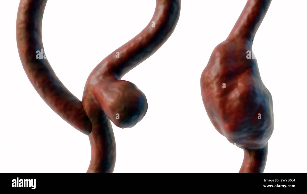 3D-Darstellung eines Sakkulaaneurysmas, auch bekannt als Beerenaneurysma und Sakkulafusiform Stockfoto