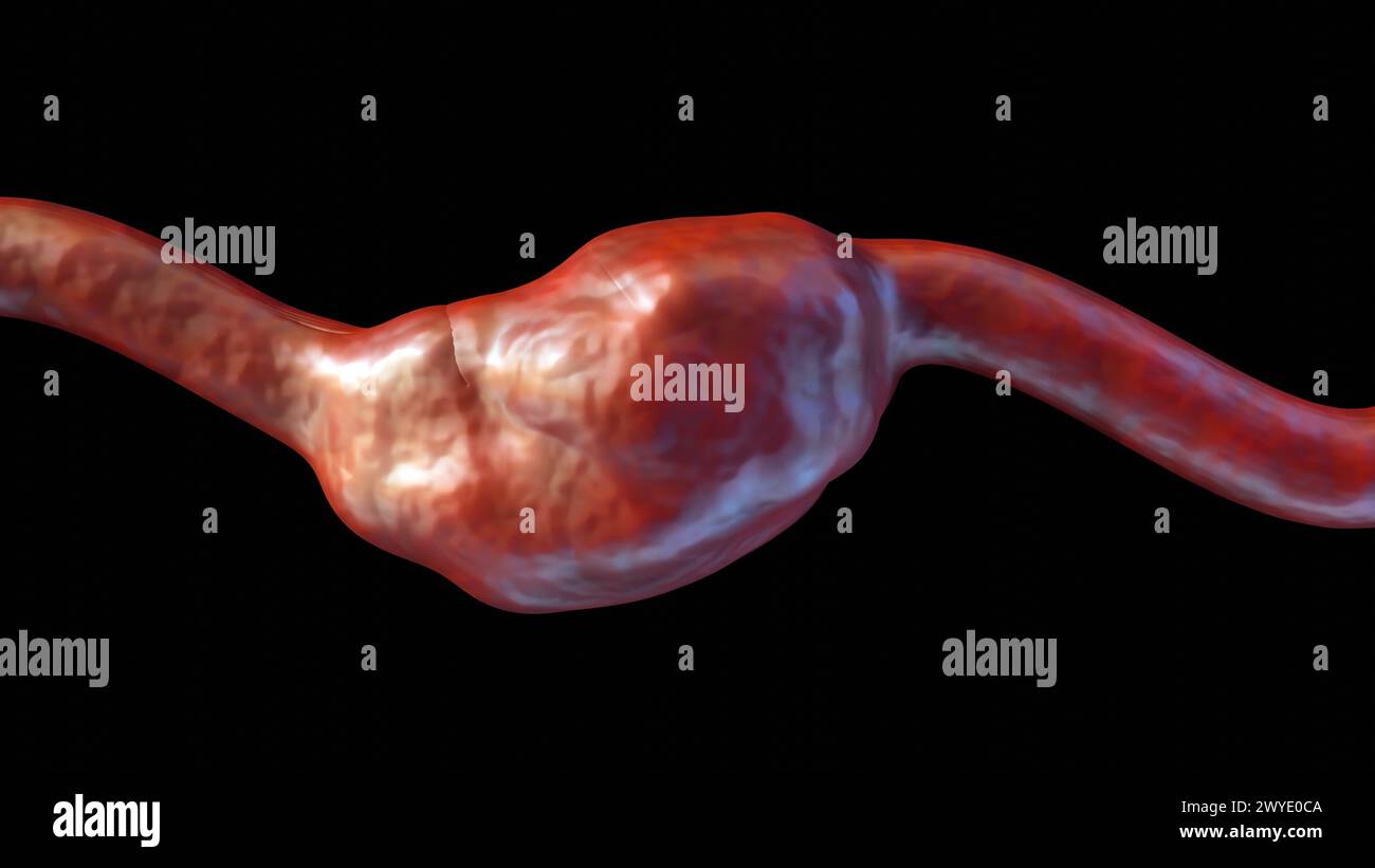 3D-Darstellung fusiformierter Aneurysma Ausbuchtungen oder Ballons auf allen Seiten des Blutgefäßes Stockfoto