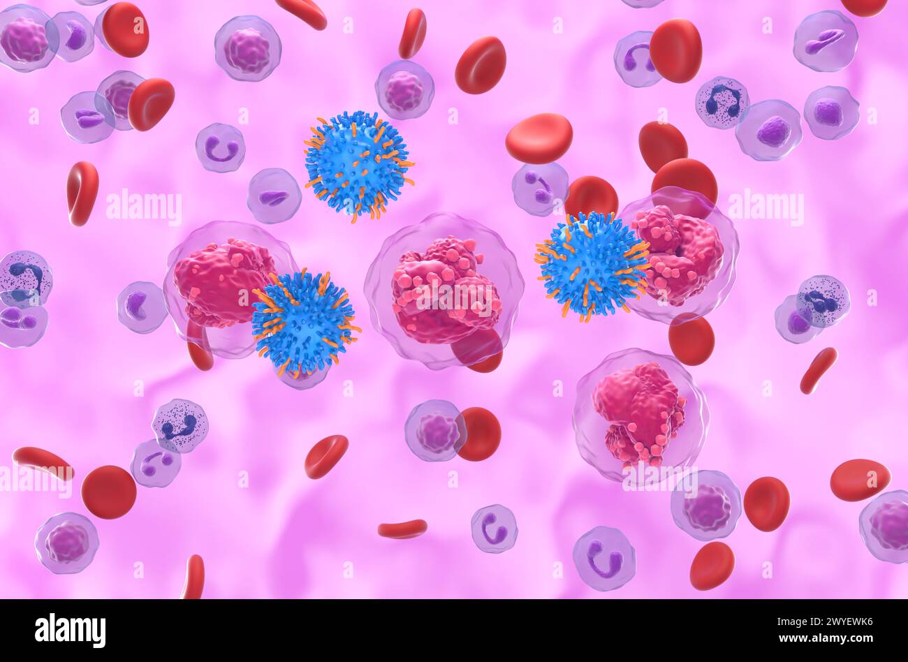 CAR-T-Zell-Therapie bei akuter lymphozytärer Leukämie (ALL) - isometrische 3D-Darstellung Stockfoto