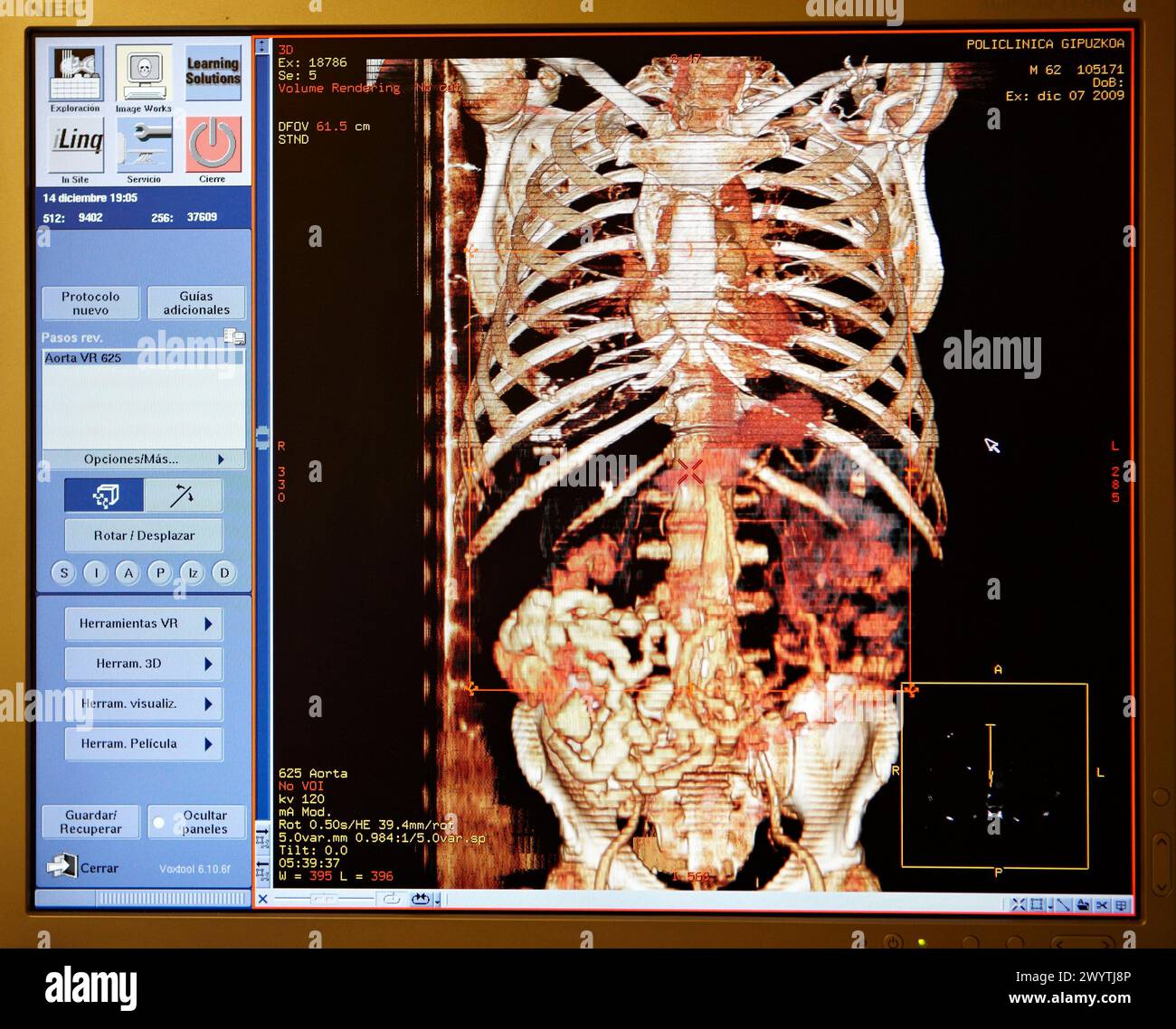 Aorta Arteria, Rippenkäfig, CAT-Scan (computergestützte Axialtomographie), Radiologie, medizinische Bildgebung zur Diagnose. Krankenhaus Policlinica Gipuzkoa, San Sebastian, Donostia, Euskadi, Spanien. Stockfoto