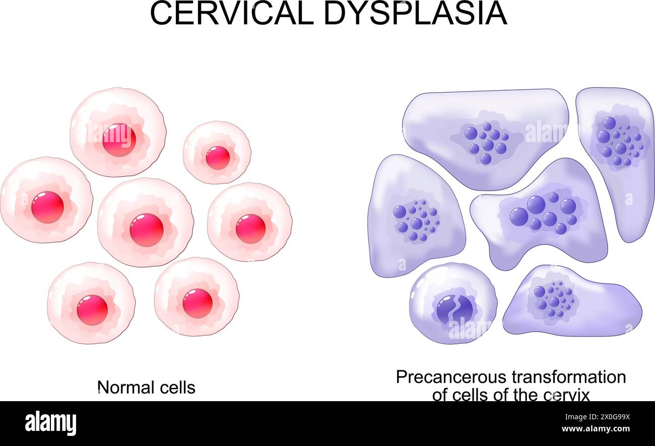 Zervikale Dysplasie. Nahaufnahme normaler Plattenepithelzellen und atypische präkanzeröse Transformation der Zervixzellen. Das Zervixkarzinom. Cer Stock Vektor