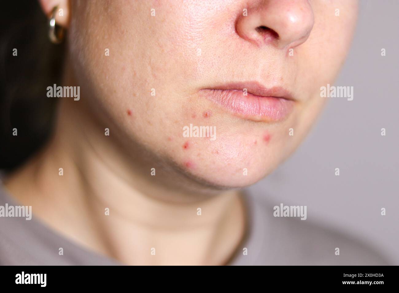 Nahaufnahme des weiblichen Gesichts mit roter problematischer Aknehaut, verschwommenem Hintergrund Stockfoto