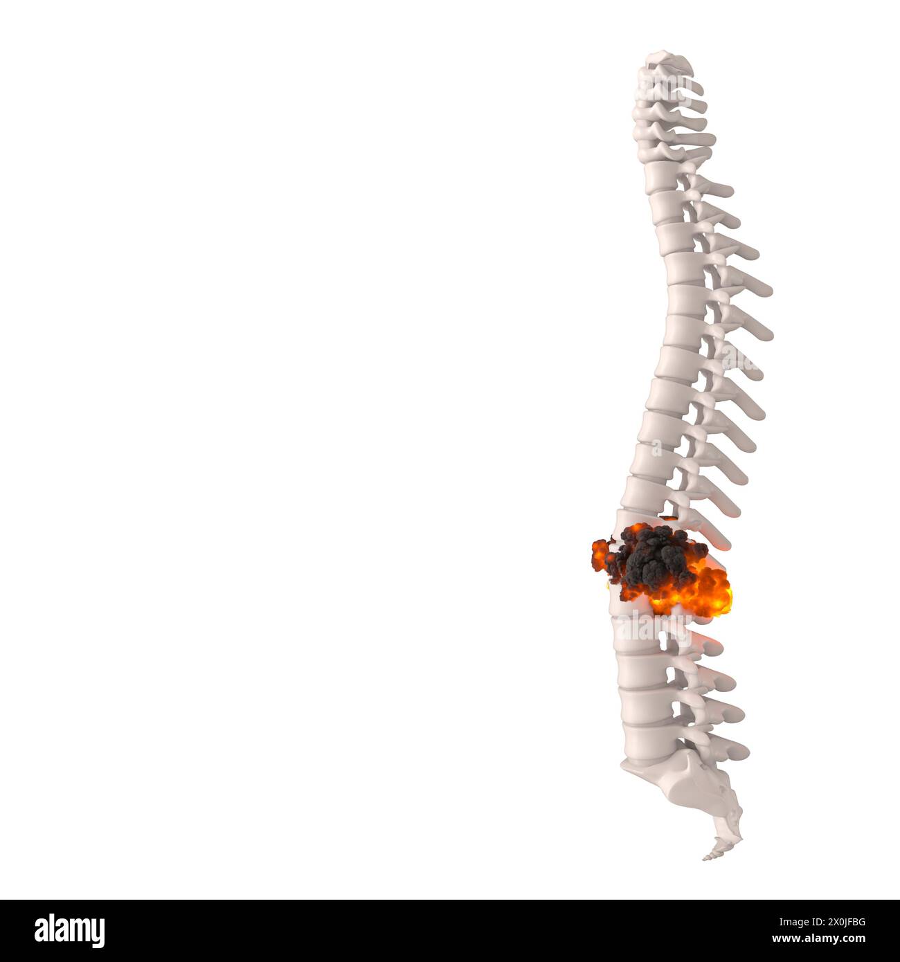 3D-Rendering einer menschlichen Wirbelsäule mit dem Konzept eines Bandscheibenvorfalls an Lendenwirbeln Stockfoto