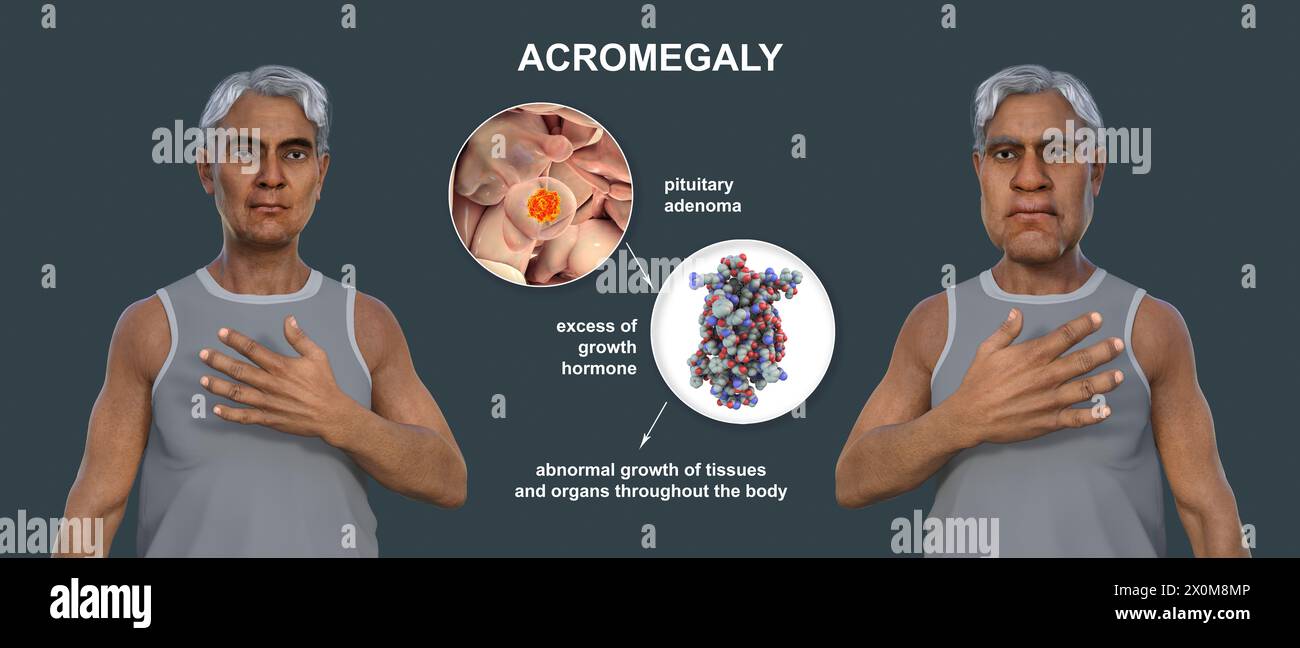 3D-Illustration, die einen gesunden Mann (links) und denselben Mann mit Akromegalie (rechts) vergleicht. Akromegalie ist eine Erkrankung, die aufgrund der Überproduktion von Somatotropin (menschliches Wachstumshormon) eine Zunahme der Hände und des Gesichts verursacht. Sie ist typischerweise das Ergebnis eines gutartigen Tumors (Adenoms), der sich auf der Hypophyse bildet. Stockfoto