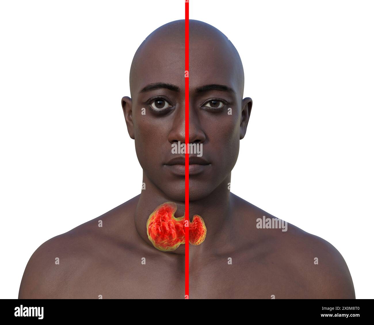 3D-Illustration eines Mannes mit einer vergrößerten Schilddrüse (Struma, Nackenbasis) und abnormer Vorwölbung der Augen (Exophthalmus), und derselbe Mann mit gesunder Schilddrüse und Augen zum Vergleich (rechts). Dies sind zwei Symptome einer überaktiven Schilddrüse, bekannt als Hyperthyreose. Stockfoto