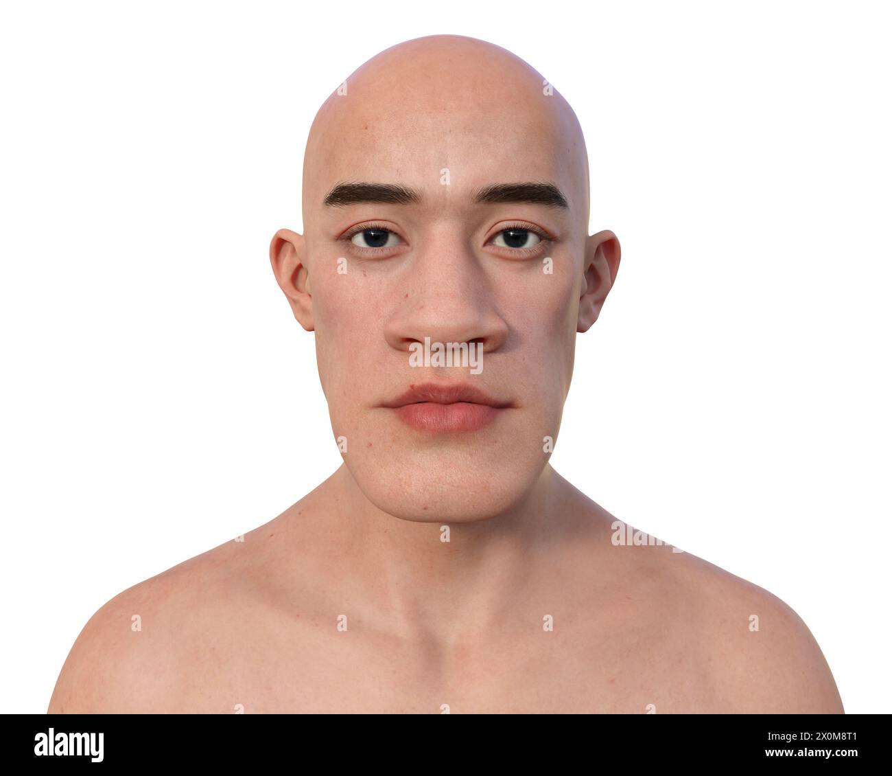 3D-Illustration eines Mannes mit Akromegalie. Dies ist eine Erkrankung, die aufgrund der Überproduktion von Somatotropin (menschliches Wachstumshormon) zu einer Vergrößerung der Hände und des Gesichts führt. Sie ist typischerweise das Ergebnis eines gutartigen Tumors (Adenoms), der sich auf der Hypophyse bildet. Stockfoto