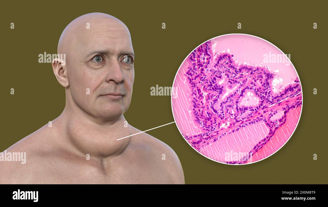 3D-Illustration eines Mannes mit einer toxischen Struma (vergrößerte Schilddrüse, Nackenbasis) und einer Nahaufnahme des betroffenen Schilddrüsengewebes. Eine Struma gilt als toxisch, wenn die vergrößerte Schilddrüse ebenfalls übermäßiges Schilddrüsenhormon produziert. Stockfoto