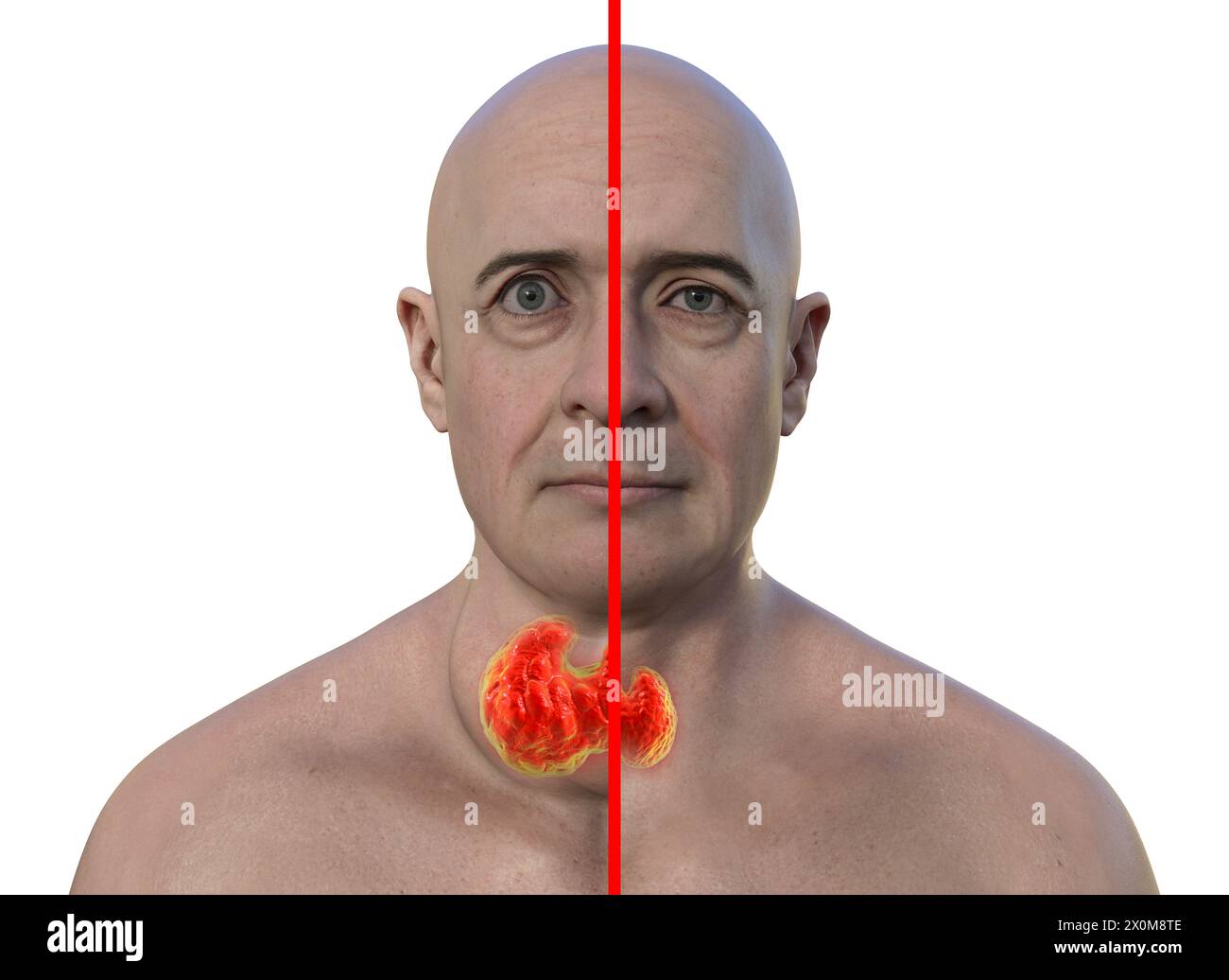 3D-Illustration eines Mannes mit einer vergrößerten Schilddrüse (Struma, Nackenbasis) und abnormer Vorwölbung der Augen (Exophthalmus), und derselbe Mann mit gesunder Schilddrüse und Augen zum Vergleich (rechts). Dies sind zwei Symptome einer überaktiven Schilddrüse, bekannt als Hyperthyreose. Stockfoto