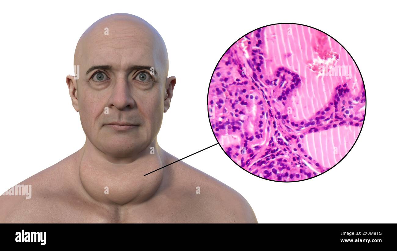 3D-Illustration eines Mannes mit einer toxischen Struma (vergrößerte Schilddrüse, Nackenbasis) und einer Nahaufnahme des betroffenen Schilddrüsengewebes. Eine Struma gilt als toxisch, wenn die vergrößerte Schilddrüse ebenfalls übermäßiges Schilddrüsenhormon produziert. Stockfoto