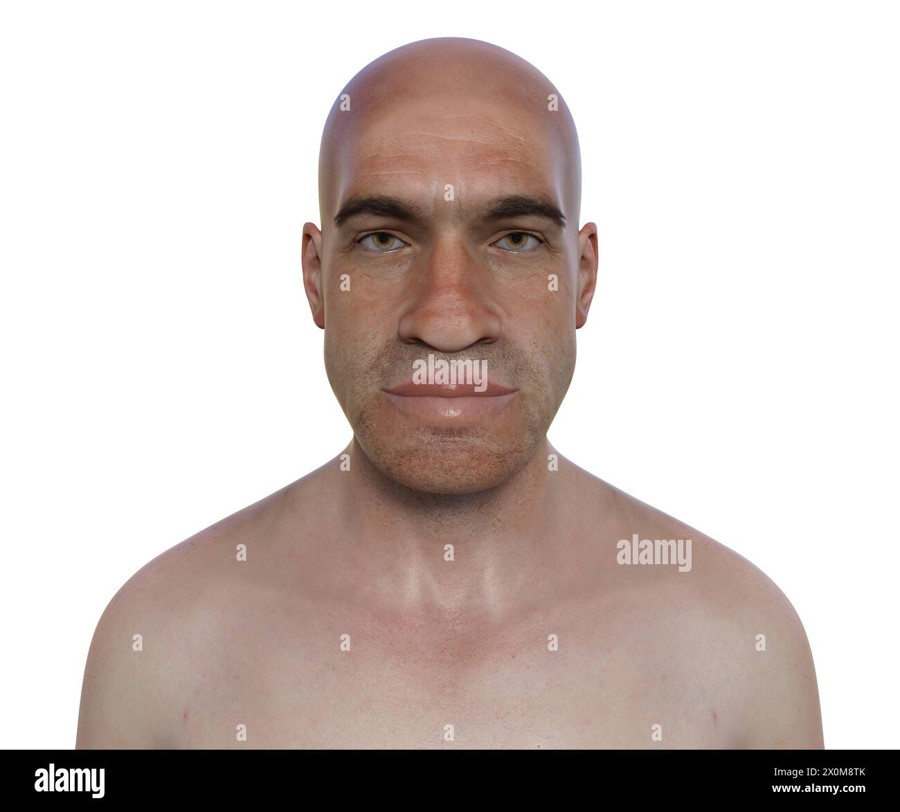 3D-Illustration eines Mannes mit Akromegalie. Dies ist eine Erkrankung, die aufgrund der Überproduktion von somat zu einer Vergrößerung der Hände und des Gesichts führt Stockfoto