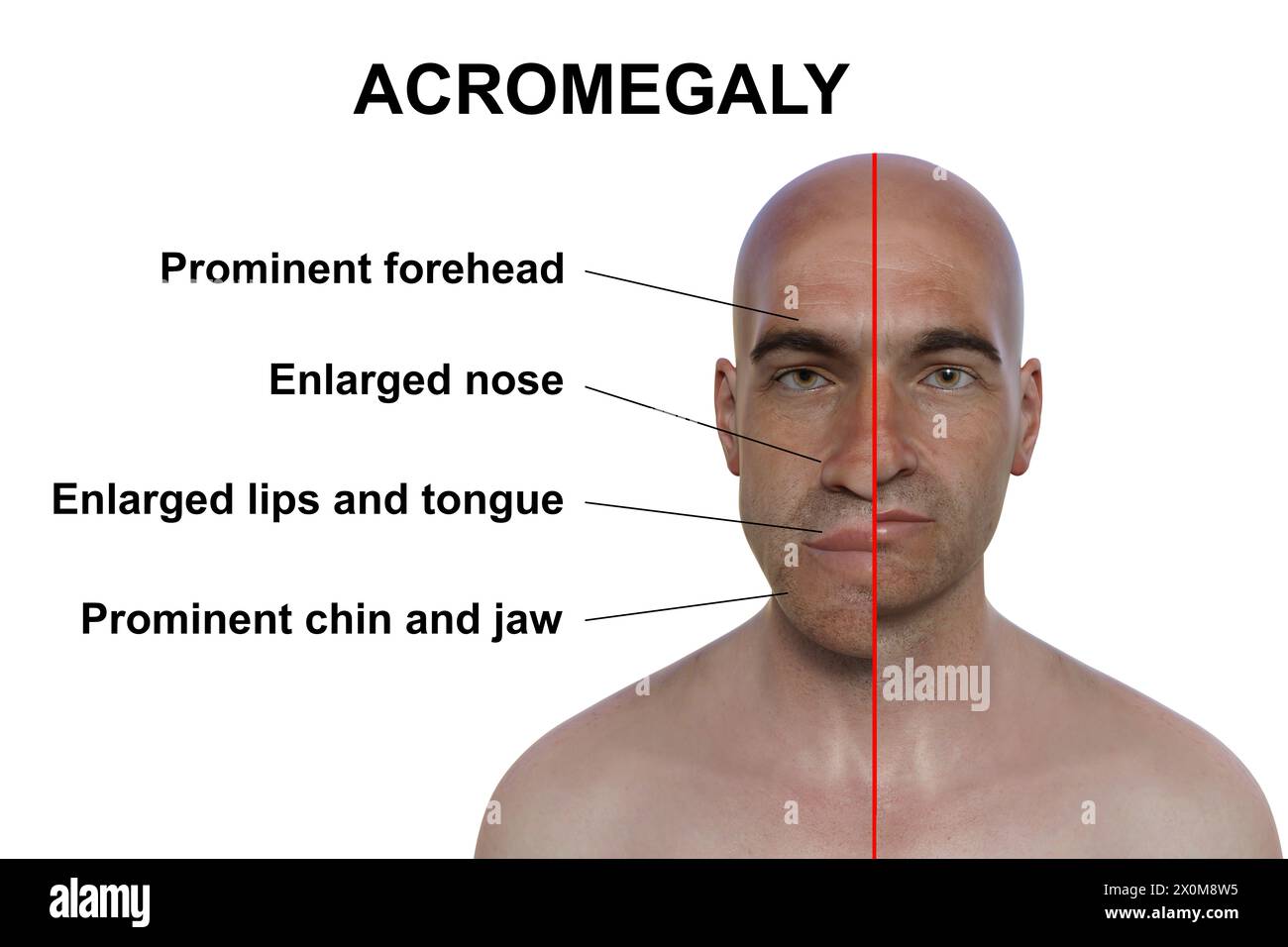 3D-Illustration, die einen Mann mit Akromegalie (links) und denselben gesunden Mann (rechts) vergleicht. Akromegalie ist eine Erkrankung, die eine Vergrößerung der Körperteile einschließlich der Gesichtszüge verursacht. Sie wird durch eine Überproduktion von Somatotropin (menschliches Wachstumshormon) verursacht, die typischerweise durch einen gutartigen Tumor (Adenom) verursacht wird, der sich auf der Hypophyse bildet. Stockfoto