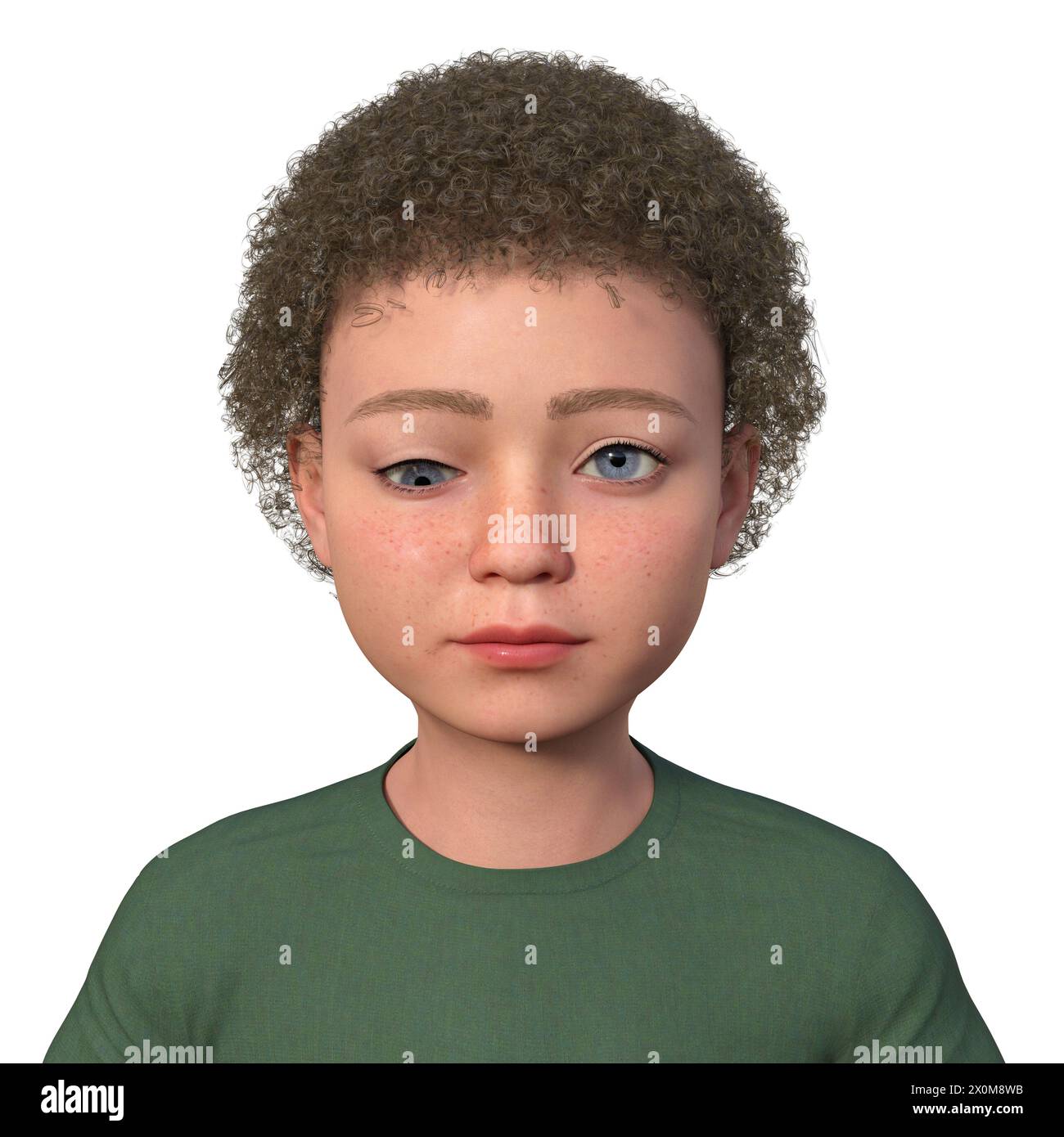 Illustration eines Kindes mit Hypotropie, das eine nach unten gerichtete Augenverschiebung zeigt. Stockfoto