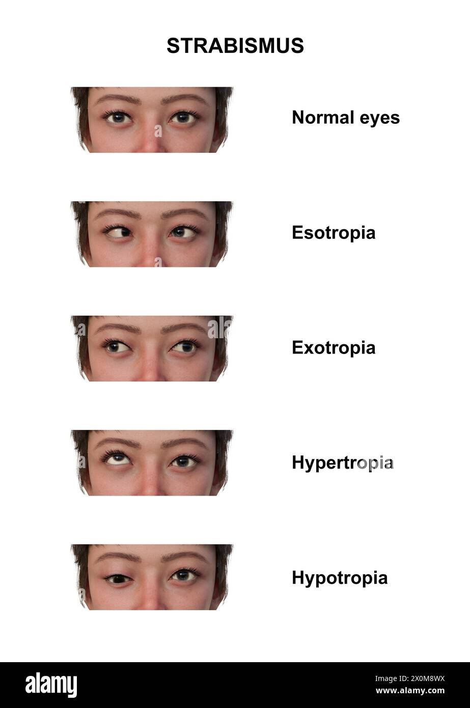 Illustration einer Frau mit verschiedenen Schielarten: Esotropie, Exotropie, Hypertropie und Hypotropie. Stockfoto