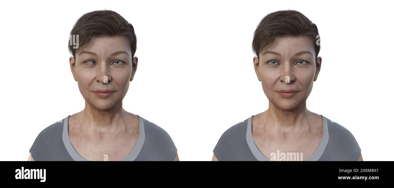 Illustration einer Frau mit Ösotropie, die eine Fehlstellung des inneren Auges zeigt, und derselben gesunden Frau. Stockfoto