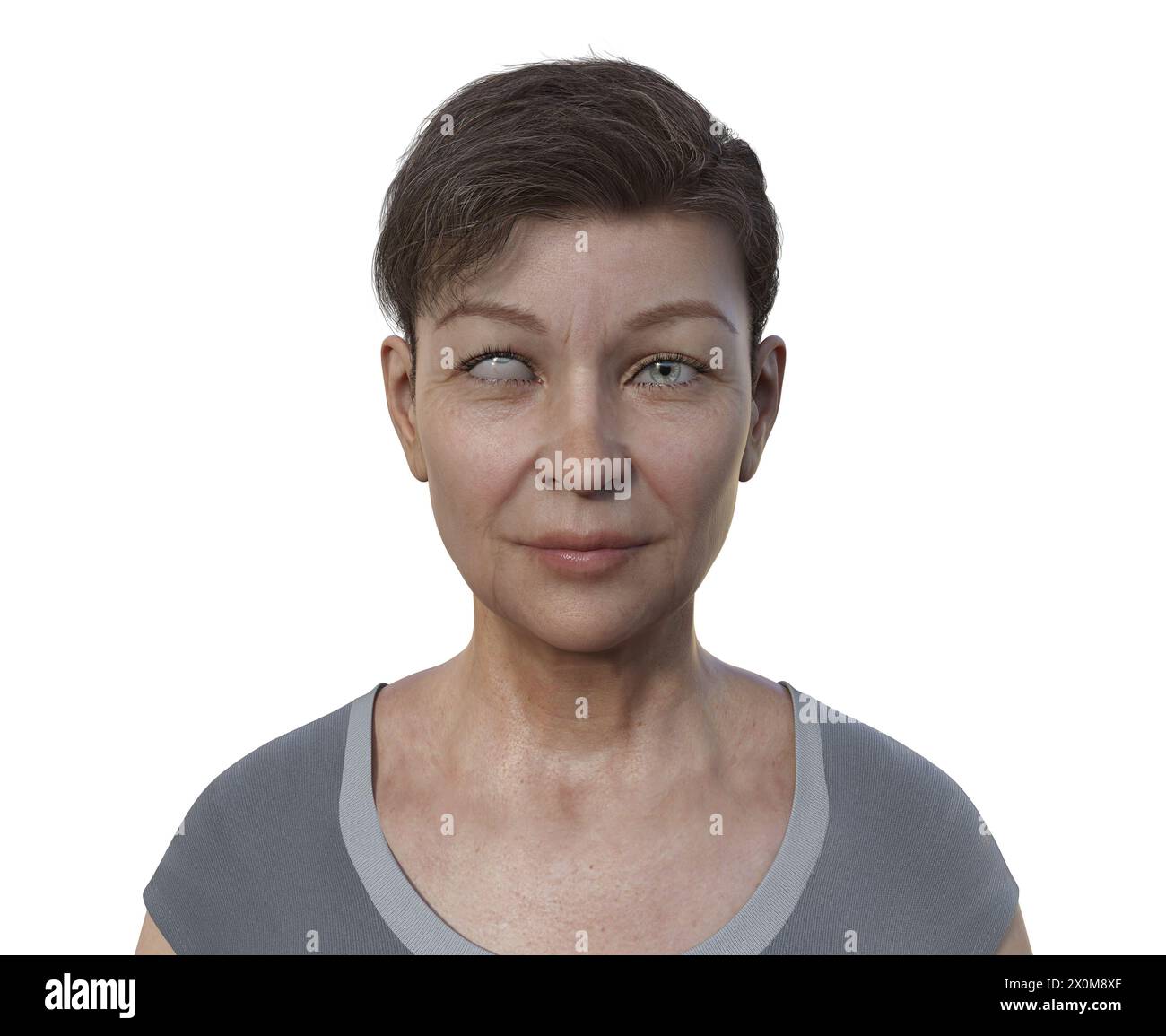 Illustration einer Frau mit Hypotropie mit nach oben gerichteter Augenfehlstellung. Stockfoto