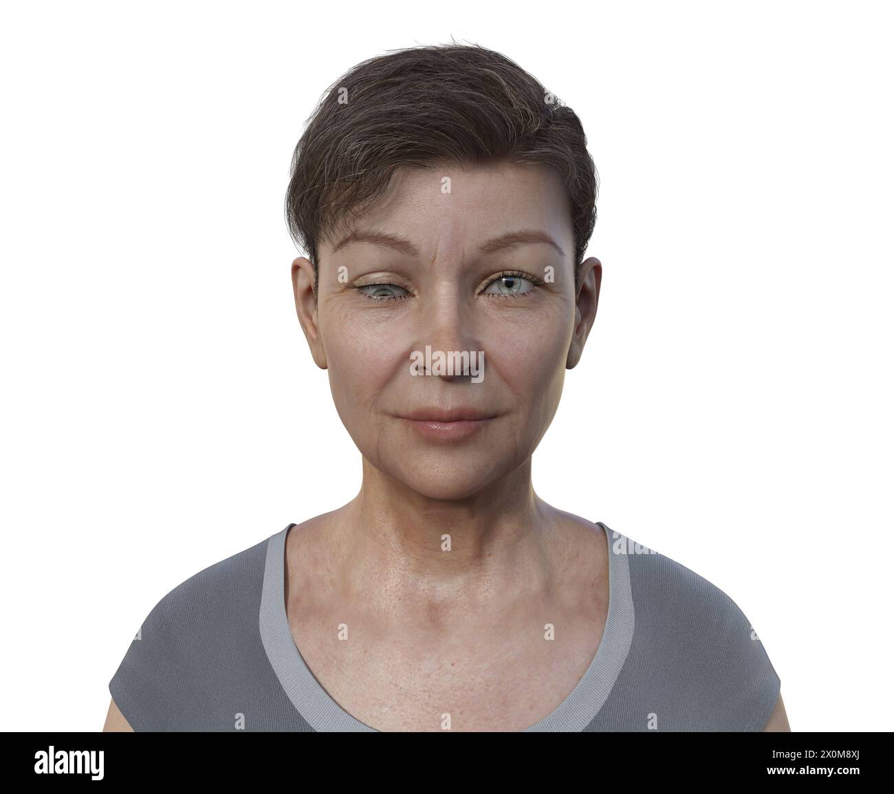 Illustration einer Hypotropie-Frau mit einer nach unten gerichteten Augenfehlstellung. Stockfoto