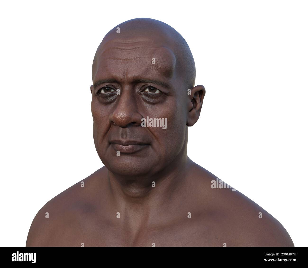 Illustration eines Lipooms auf der Stirn eines Mannes, eines nicht-kanzerösen Tumors aus Fettgewebe. Stockfoto