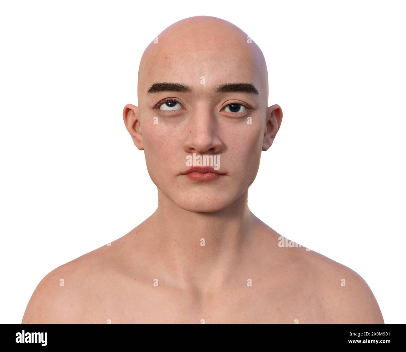 Illustration eines Menschen mit Hypotropie mit aufwärts gerichteter Augenfehlstellung. Stockfoto