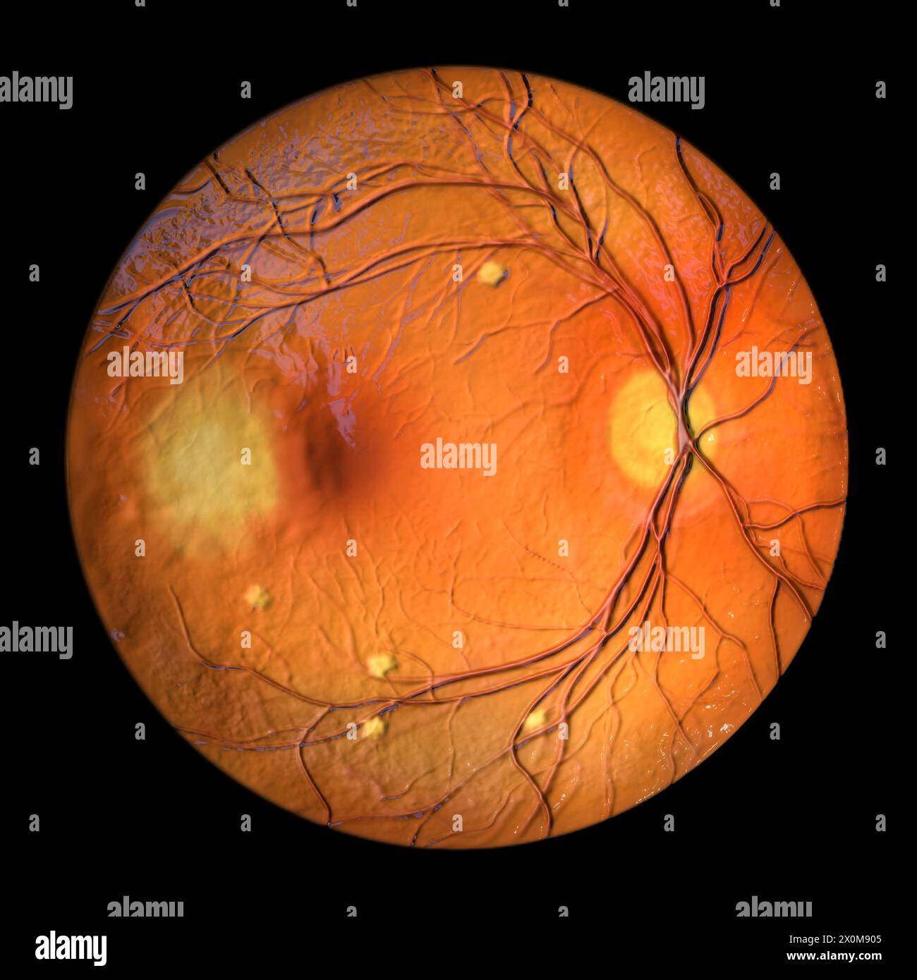 Darstellung einer blastomykosebefallenen Netzhaut aus der Ophthalmoskopie. Dies ist eine Infektion, die durch Blastomyces dermatitidis-Pilze verursacht wird. Die Netzhaut weist verstreute gelbe Aderhautinfiltrate und eine Aderhautläsion auf. Stockfoto