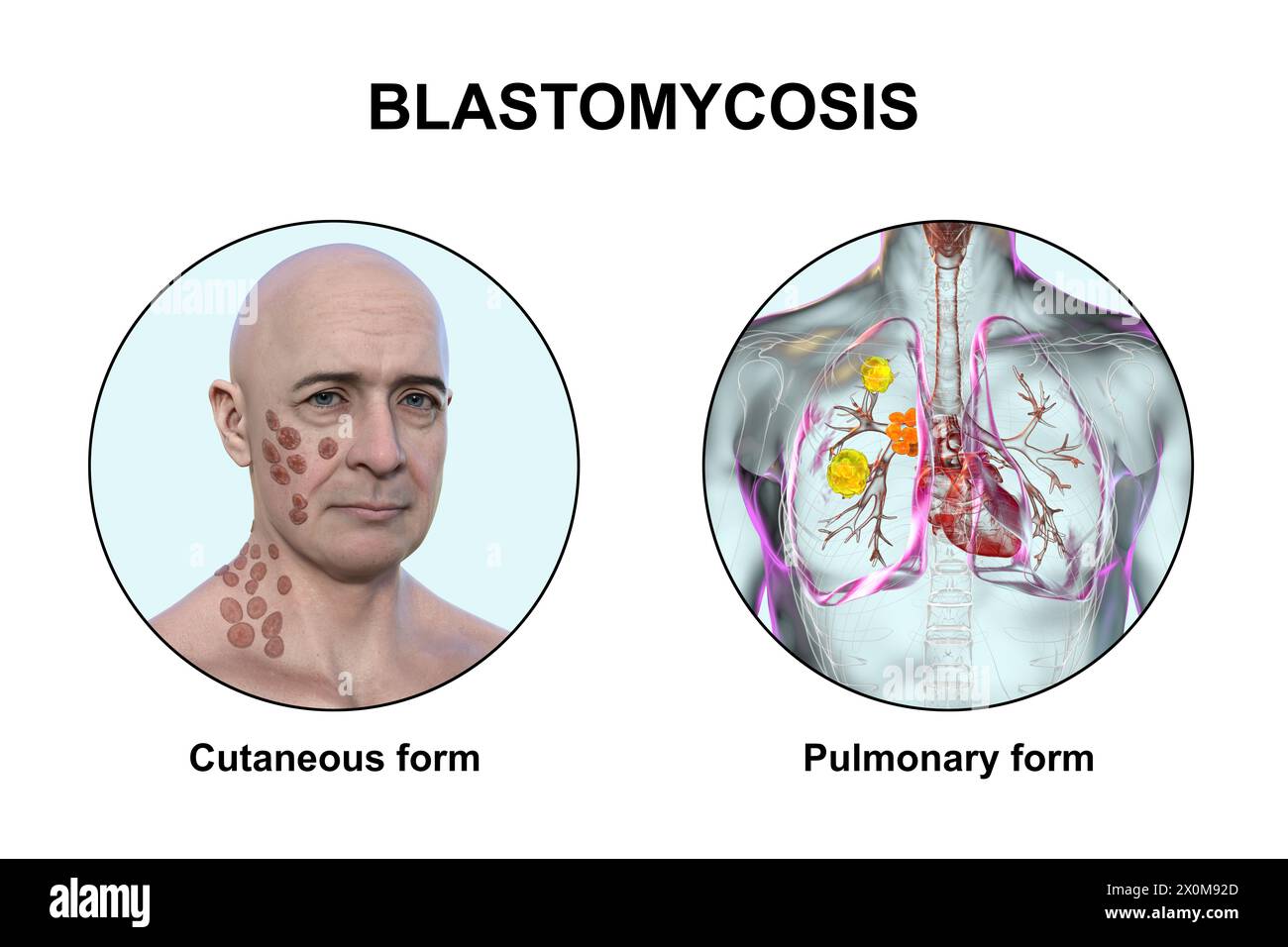 3D-Illustration, die zwei klinische Darstellungen der Blastomykose zeigt: Kutan (die Haut betrifft) und pulmonal (die Lunge betrifft). Blastomykose ist eine Pilzinfektion, die nach Inhalation von Blastomyces dermatitidis-Sporen auftreten kann. Es ist oft asymptomatisch, aber wenn Symptome entwickeln, betreffen sie vor allem die Lunge, wobei einige Patienten auch Hautläsionen entwickeln. Stockfoto