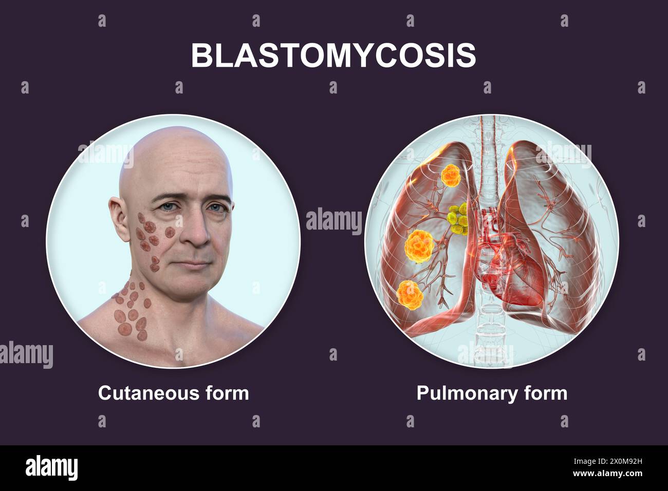 3D-Illustration, die zwei klinische Darstellungen der Blastomykose zeigt: Kutan (die Haut betrifft) und pulmonal (die Lunge betrifft). Blastomykose ist eine Pilzinfektion, die nach Inhalation von Blastomyces dermatitidis-Sporen auftreten kann. Es ist oft asymptomatisch, aber wenn Symptome entwickeln, betreffen sie vor allem die Lunge, wobei einige Patienten auch Hautläsionen entwickeln. Stockfoto
