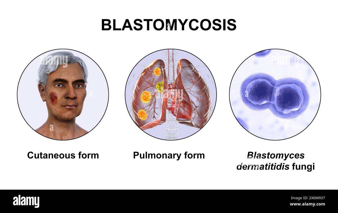 3D-Illustration mit zwei klinischen Darstellungen der Blastomykose und einer Nahaufnahme von Blastomyces dermatitidis-Pilzen. Blastomykose ist eine Pilzinfektion, die auftreten kann, wenn Blastomyces dermatitidis Sporen inhaliert werden. Infektionen betreffen vor allem die Lunge (Lunge), wobei einige Patienten auch Hautsymptome (kutane) wie Läsionen entwickeln. Stockfoto