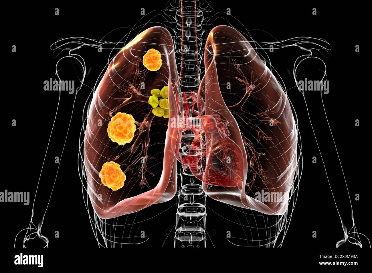 3D-Darstellung der pulmonalen Blastomykose und Nahaufnahme des Erreger-Pilzes Blastomyces dermatitidis. Blastomykose ist oft asymptomatisch, kann aber Lungenläsionen (grün) und vergrößerte bronchiale Lymphknoten (gelb) verursachen. Stockfoto