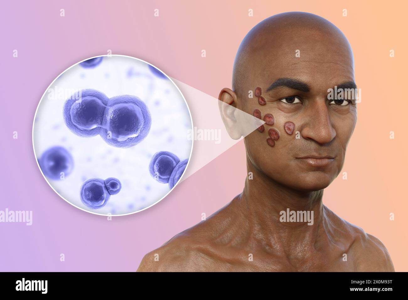 3D-Darstellung eines Mannes mit multiplen Gesichts- und Halsläsionen durch Blastomykose und Nahaufnahme der verursachenden Blastomyces dermatitidis-Pilze. Blastomykose ist oft asymptomatisch, kann aber Lungenprobleme verursachen. In einigen Fällen entwickeln sich solche Läsionen auf der Haut (kutane Blastomykose), die zu irreversiblen Narbenbildungen führen können. Stockfoto