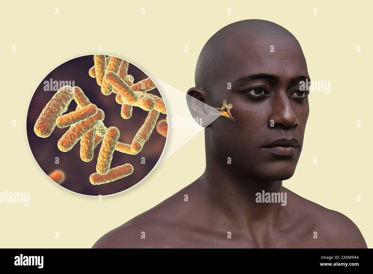 3D-Darstellung eines Mannes mit einer bakteriellen Mittelohrinfektion (Otitis Media) und einer Nahaufnahme der verursachenden Bakterien. Zu den Symptomen gehören Entzündungen, Flüssigkeitsansammlungen und Schmerzen im Ohr. Stockfoto
