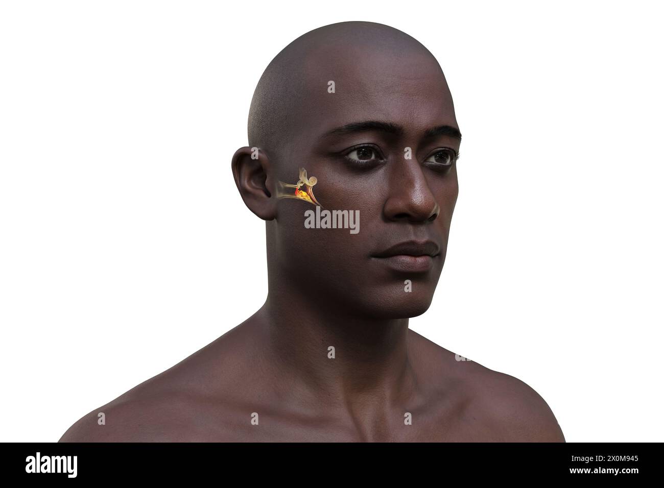 3D-Illustration eines Mannes mit einer Infektion des Mittelohrs, bekannt als Otitis Media. Dies verursacht Entzündungen, Flüssigkeitsansammlungen und Schmerzen im Ohr. Stockfoto
