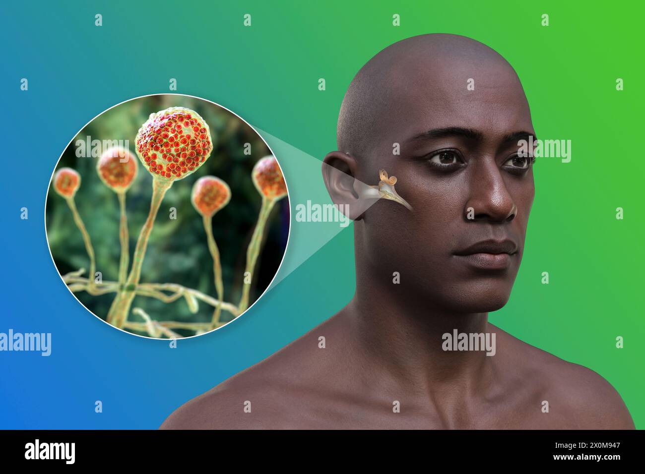 3D-Darstellung eines Mannes mit einer Mittelohrentzündung (Otitis Media) und einer Nahaufnahme von Pilzen, einem der potentiellen Erreger. Zu den Symptomen gehören Entzündungen, Flüssigkeitsansammlungen und Schmerzen im Ohr. Stockfoto