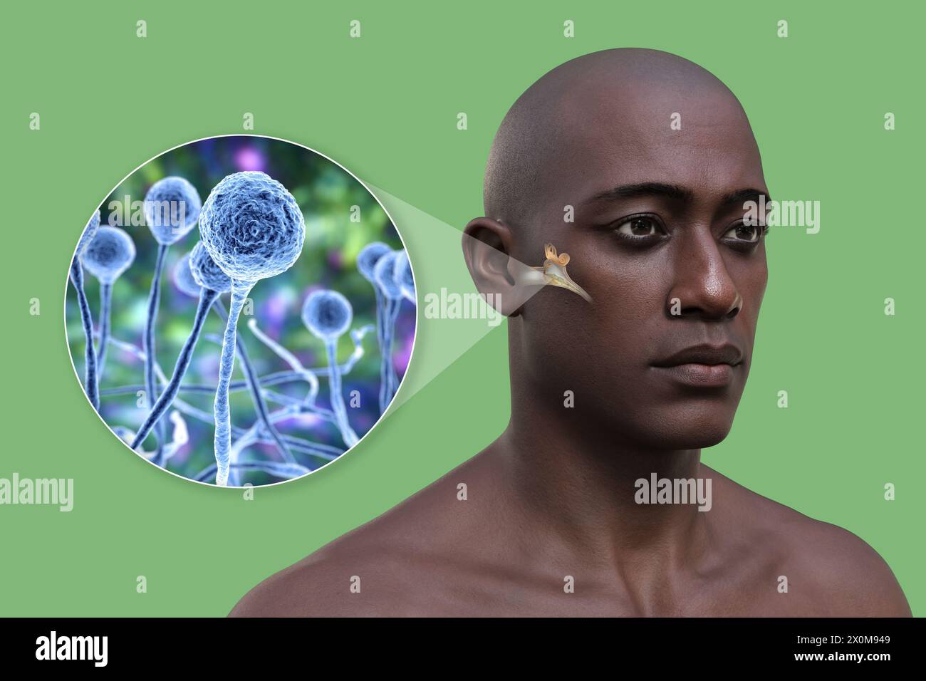 3D-Darstellung eines Mannes mit einer Mittelohrentzündung (Otitis Media) und einer Nahaufnahme von Pilzen, einem der potentiellen Erreger. Zu den Symptomen gehören Entzündungen, Flüssigkeitsansammlungen und Schmerzen im Ohr. Stockfoto