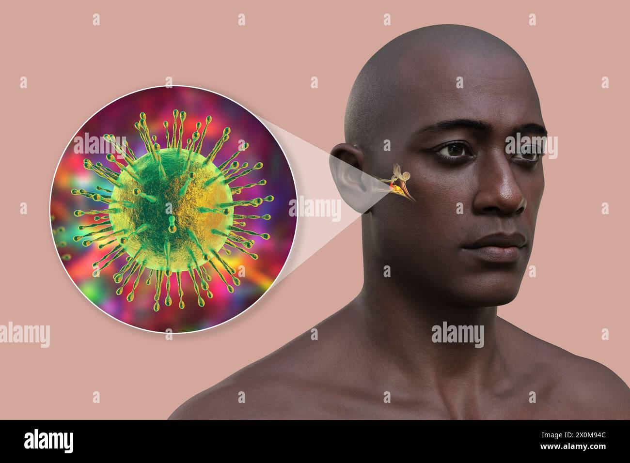 3D-Darstellung eines Mannes mit einer viralen Mittelohrinfektion (Otitis Media) und einer Nahaufnahme des ursächlichen Virus. Zu den Symptomen gehören Entzündungen, Flüssigkeitsansammlungen und Schmerzen im Ohr. Stockfoto